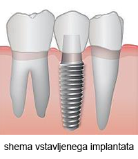 zobni implantant